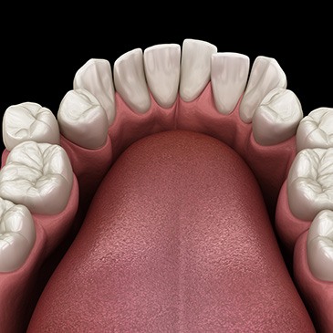 Illustration of crooked teeth