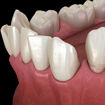 Illustration of gapped teeth