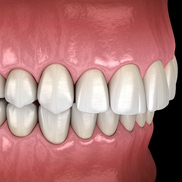 Illustration of an overbite