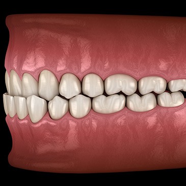 Illustration of an underbite