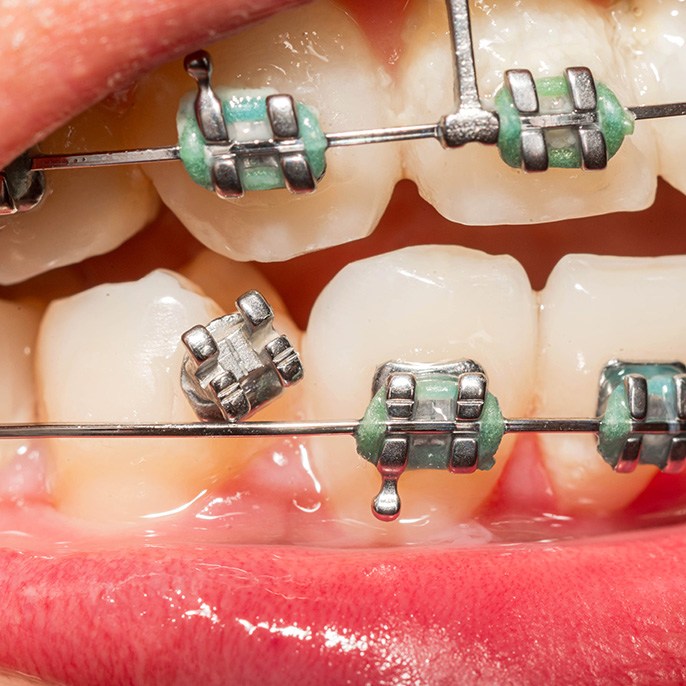 Close-up of loose bracket, an example of an orthodontic emergency in Columbus