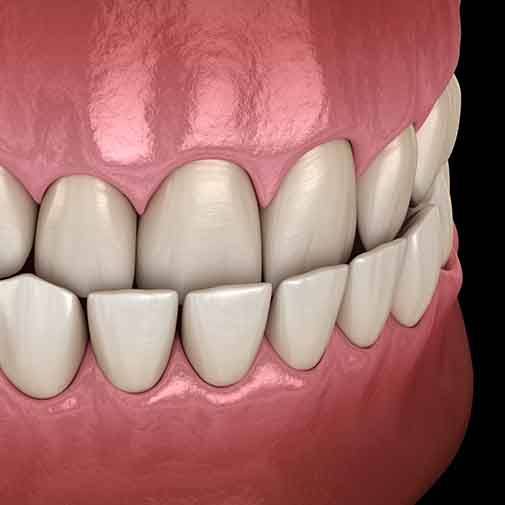 Illustration of underbite