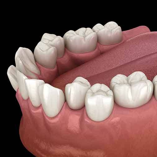 Illustration of crowded teeth?