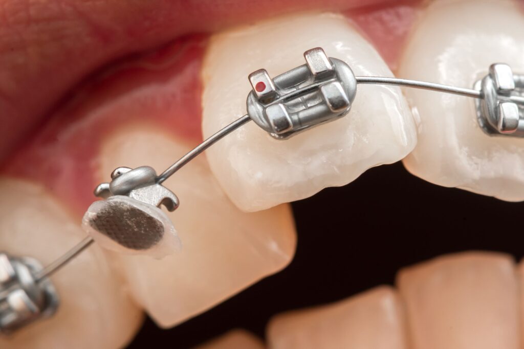 Braces bracket detached from tooth